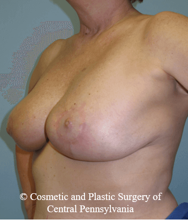 Breast Lift (Mastopexy) After
