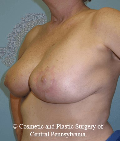 Breast Lift (Mastopexy) After