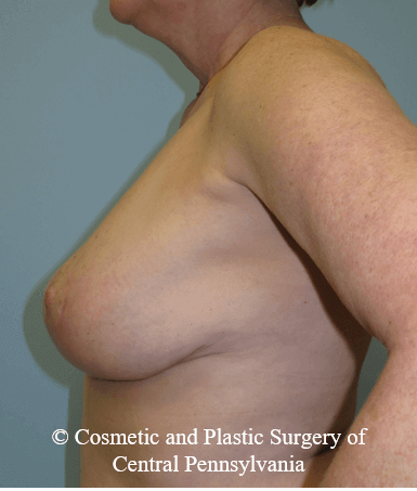 Breast Lift (Mastopexy) After