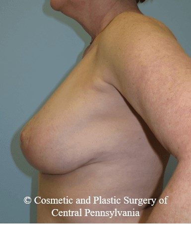 Breast Lift (Mastopexy) After