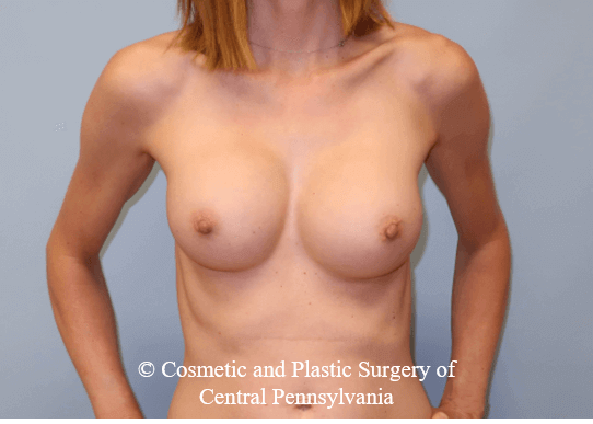 Breast Augmentation After