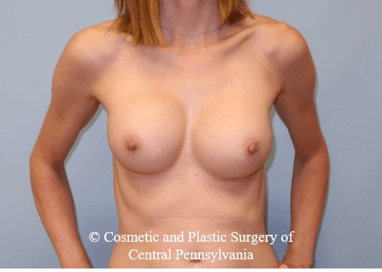 Breast Augmentation After