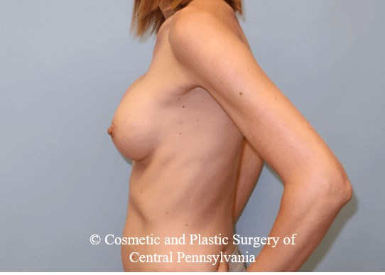 Breast Augmentation After