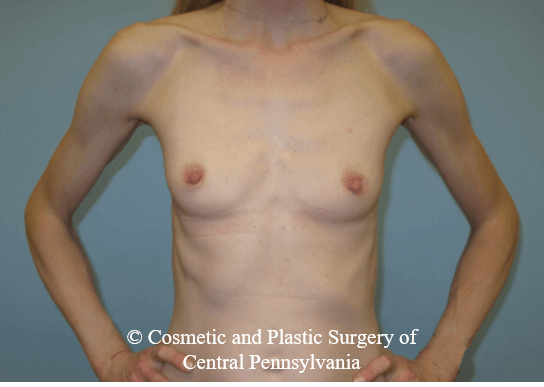 Breast Augmentation Before