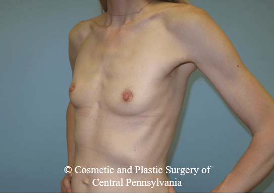 Breast Augmentation Before