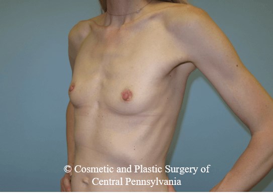 Breast Augmentation Before