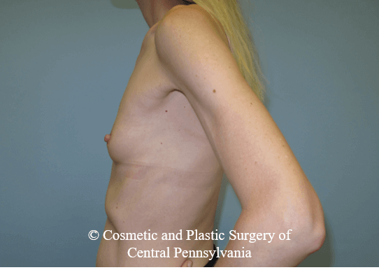 Breast Augmentation Before