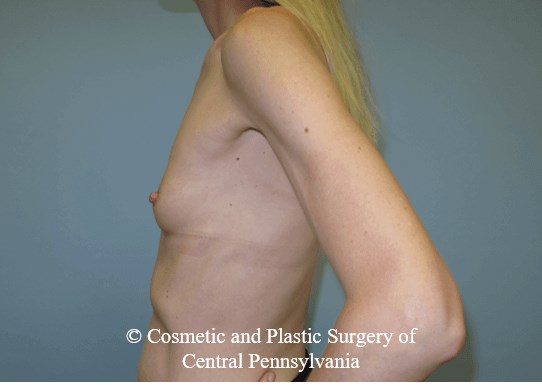 Breast Augmentation Before
