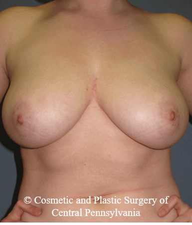 Breast Reduction Before