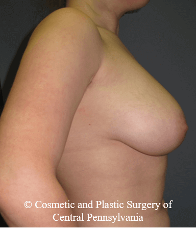 Breast Reduction Before
