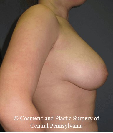 Breast Reduction Before