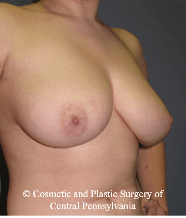 Breast Reduction Before