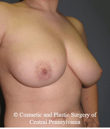Breast Reduction Before