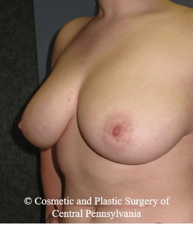 Breast Reduction Before