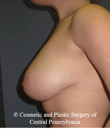 Breast Reduction Before