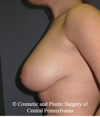 Breast Reduction Before