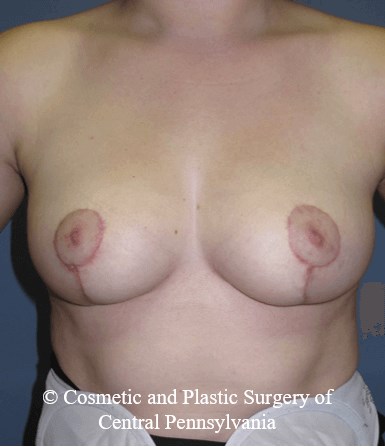 Breast Reduction After