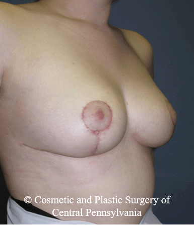 Breast Reduction After