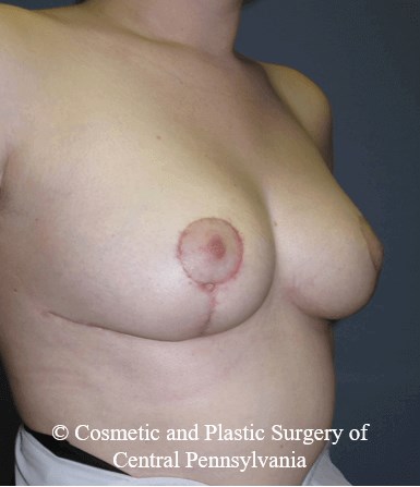 Breast Reduction After