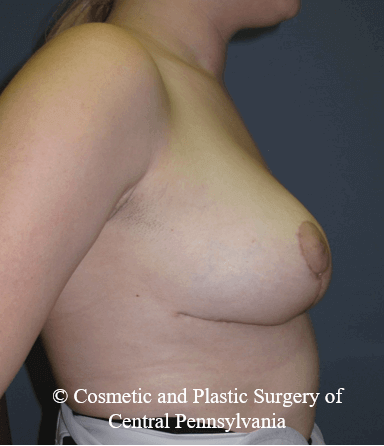 Breast Reduction After