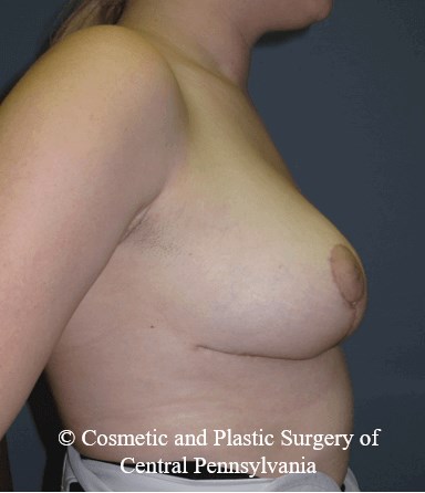 Breast Reduction After