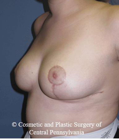 Breast Reduction After