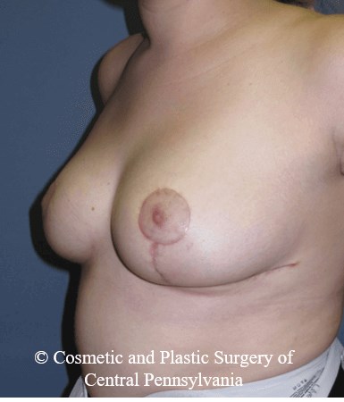 Breast Reduction After