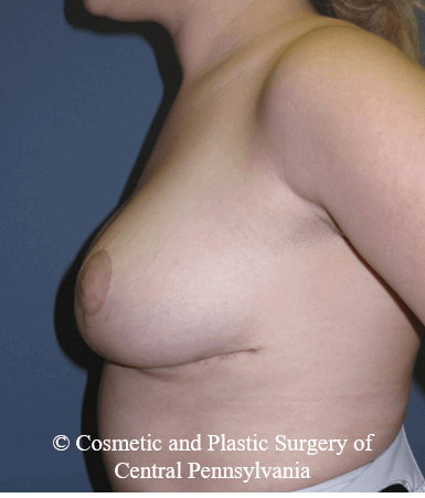 Breast Reduction After