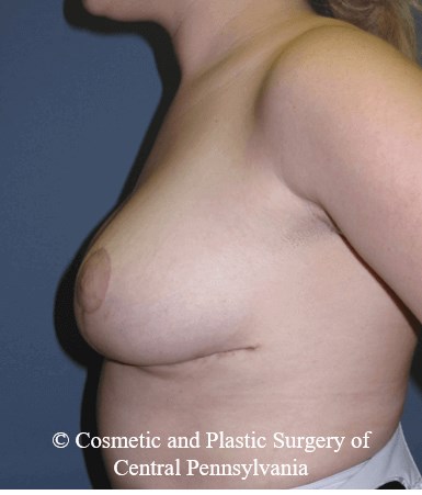 Breast Reduction After