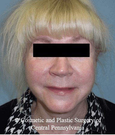 Facelift After