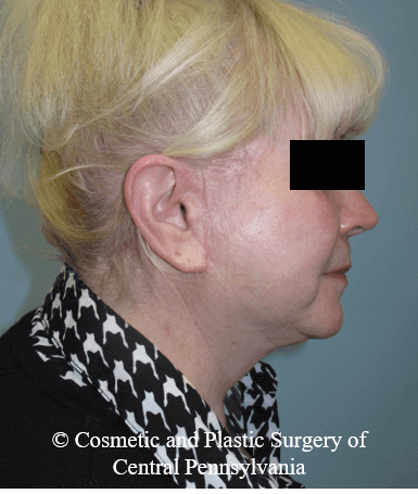 Facelift After