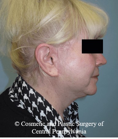 Facelift After