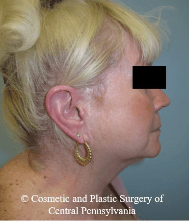Facelift Before
