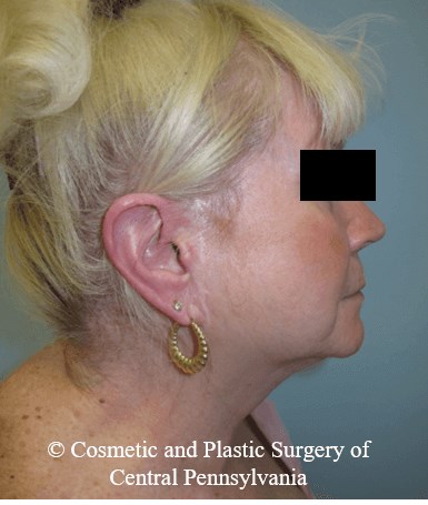 Facelift Before