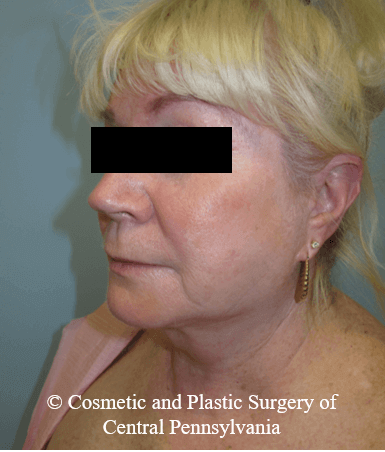 Facelift Before