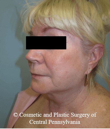 Facelift Before