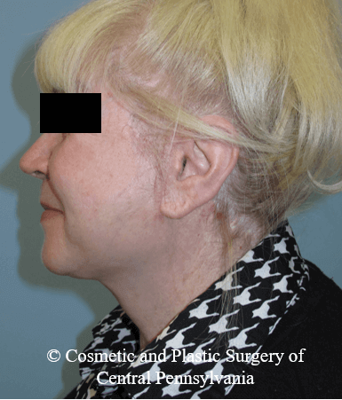 Facelift After