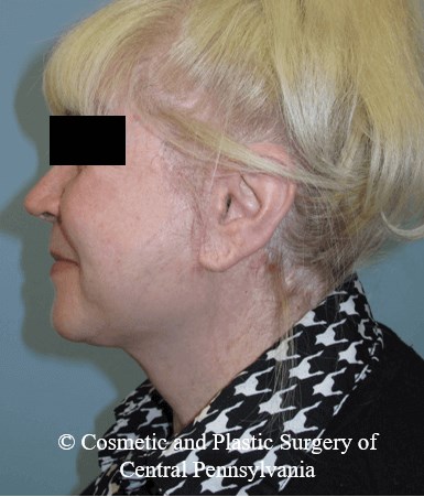 Facelift After