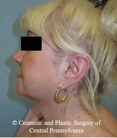 Facelift Before