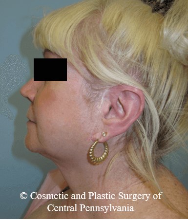 Facelift Before
