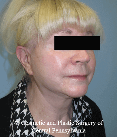 Facelift After