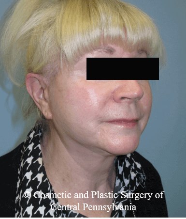 Facelift After