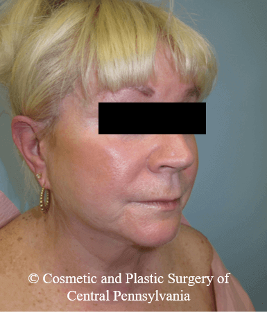Facelift Before