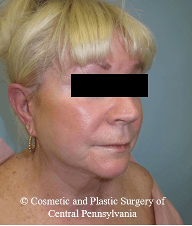 Facelift Before