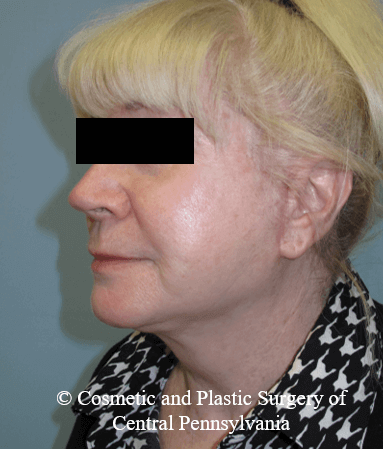 Facelift After