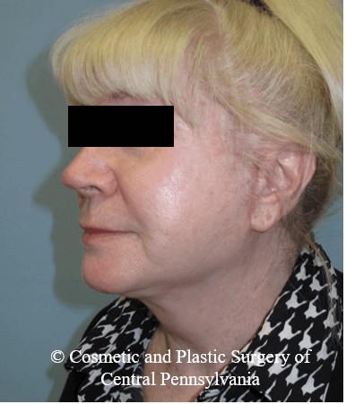 Facelift After