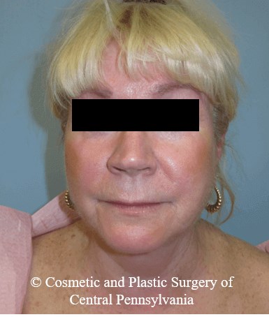 Facelift Before