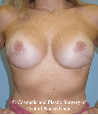 Breast Reconstruction After