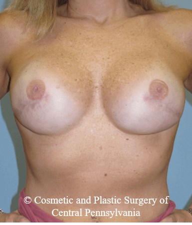 Breast Reconstruction After