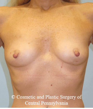 Breast Reconstruction Before